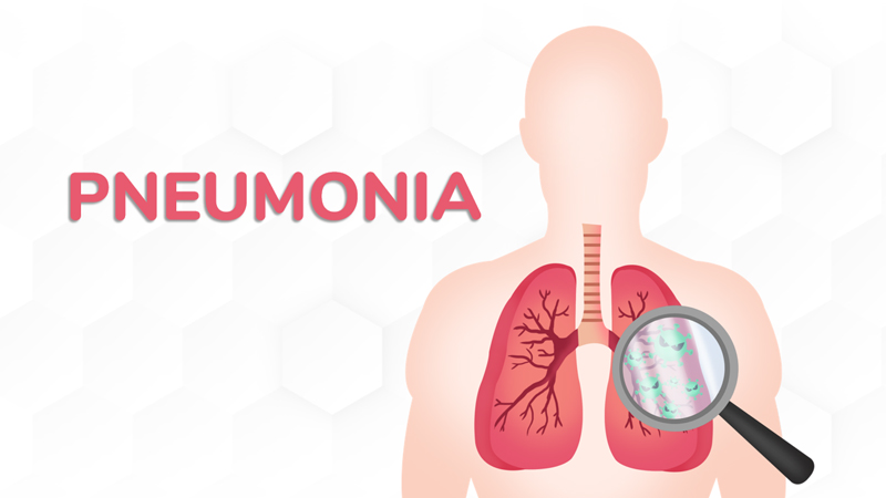 Pneumonia: Penyebab, Gejala, Penanganan, dan Pencegahan – PAFI Tubei