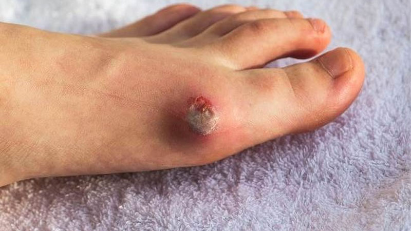 Risiko Komplikasi Akibat Luka Diabetes yang Tidak Tertangani – PAFI Tubei